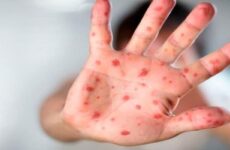 Vacunarán a niños  contra sarampión